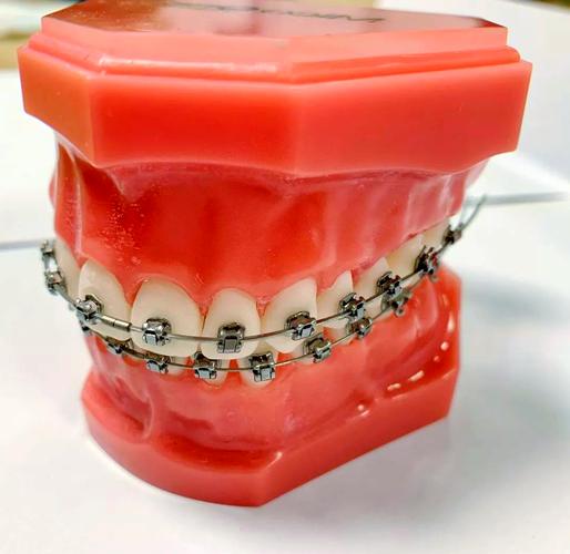 自锁托槽矫正牙齿，多大年龄做最合适？-图1