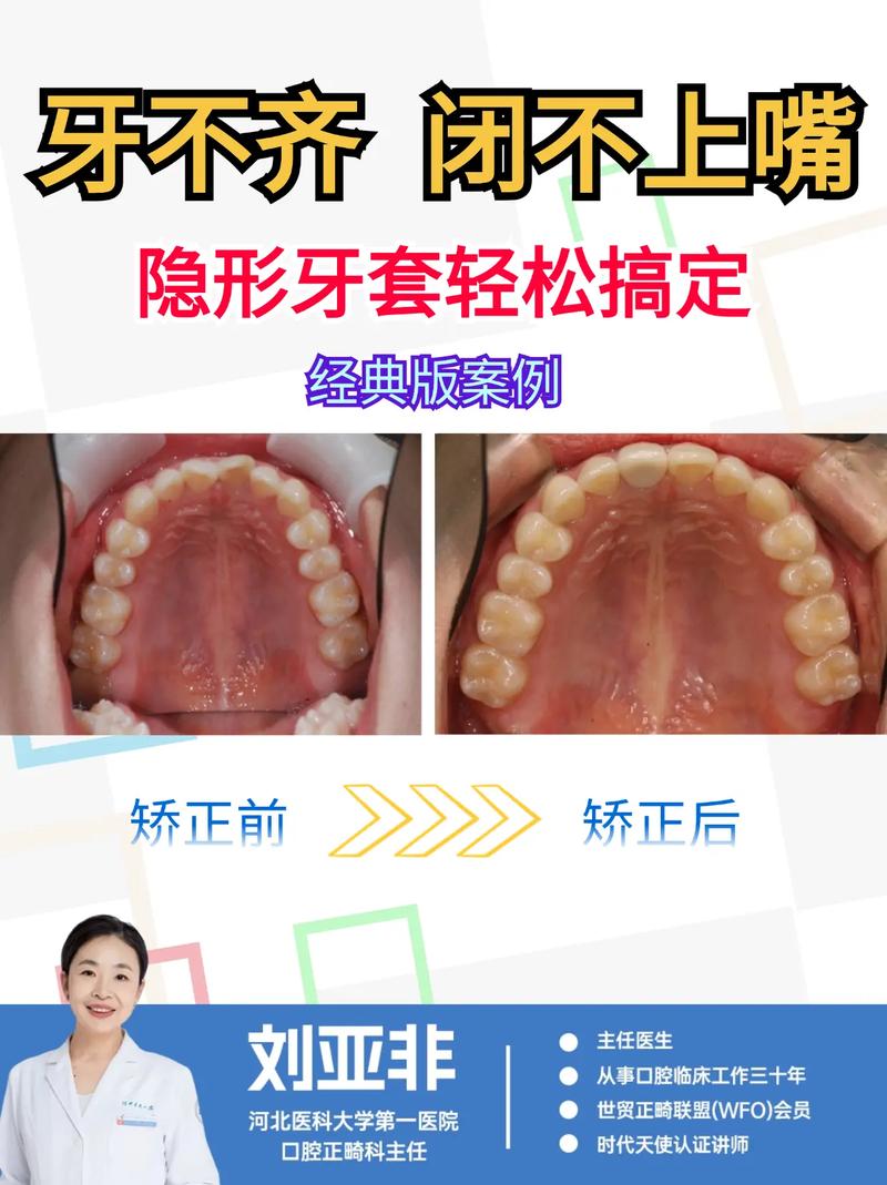 矫正牙齿牙套怎么戴？详细步骤与注意事项全解析-图1