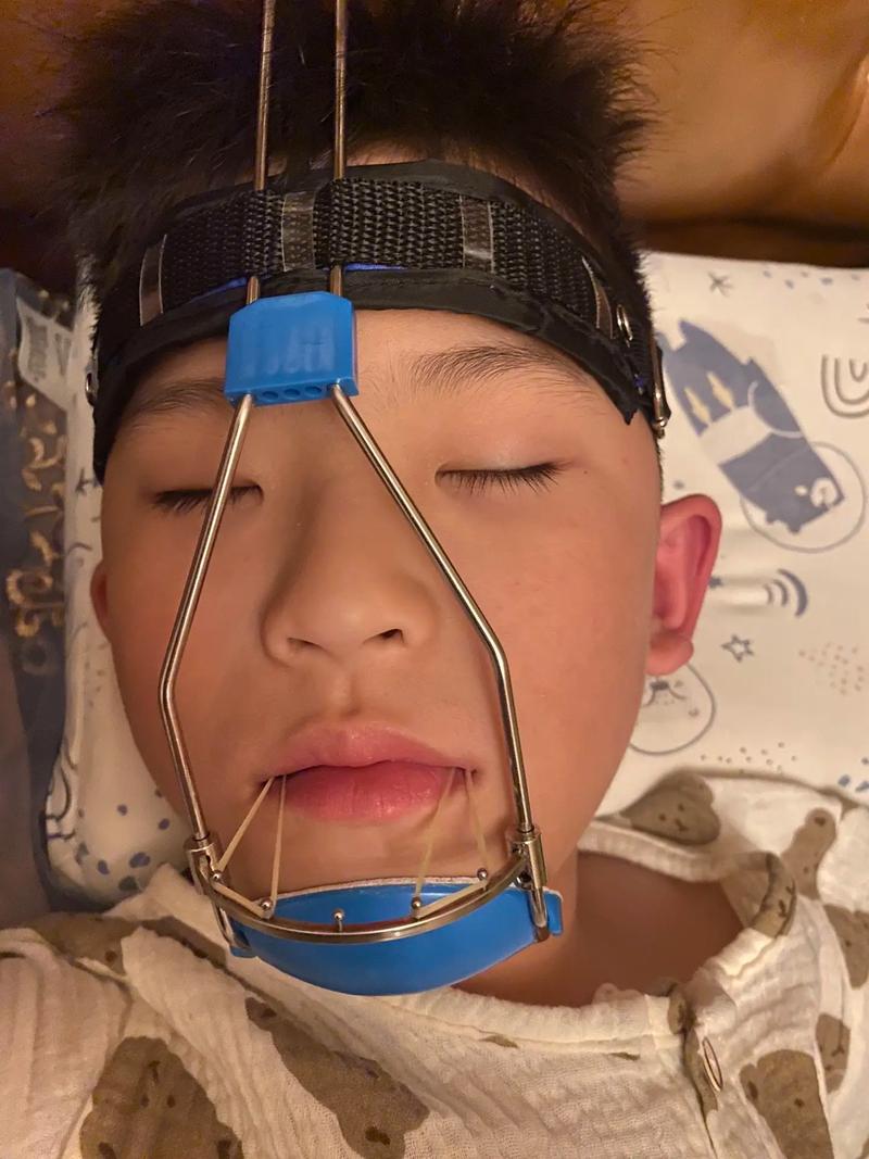 矫正牙齿牙套怎么戴？详细步骤与注意事项全解析-图2