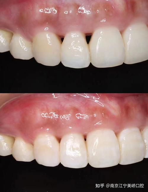 矫正牙齿 牙齿是黑的-图2 矫正牙齿 牙齿是黑的-图2