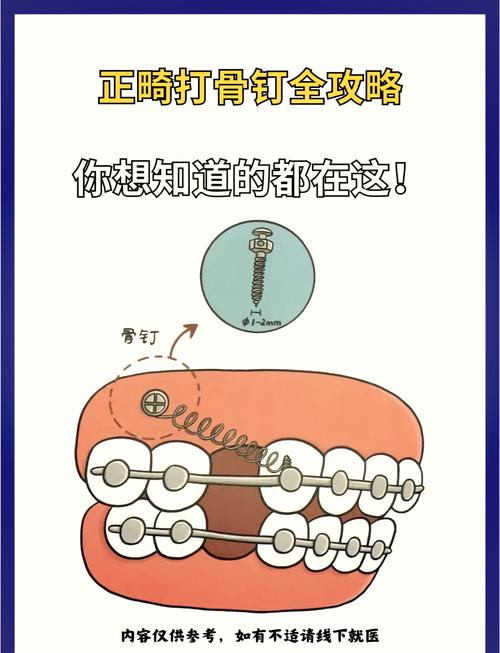 牙齿矫正打骨钉的作用究竟是什么？为何如此关键？-图3
