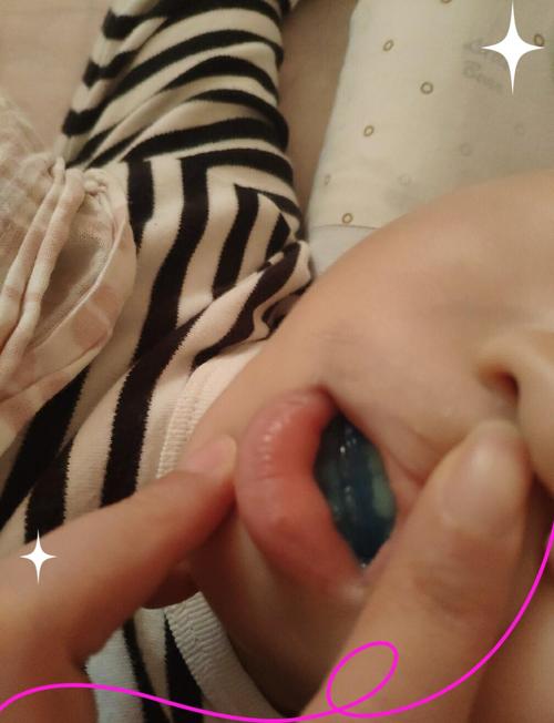 儿童MRC牙齿矫正器效果怎么样？几岁戴最合适？需注意什么？-图3