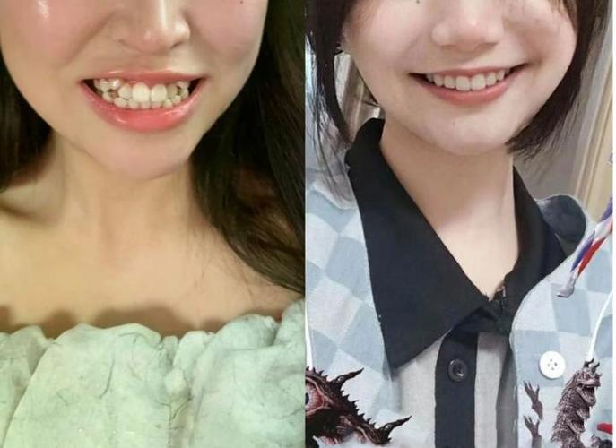 矫正牙齿会有后遗症吗?-图3 矫正牙齿会有后遗症吗?-图3