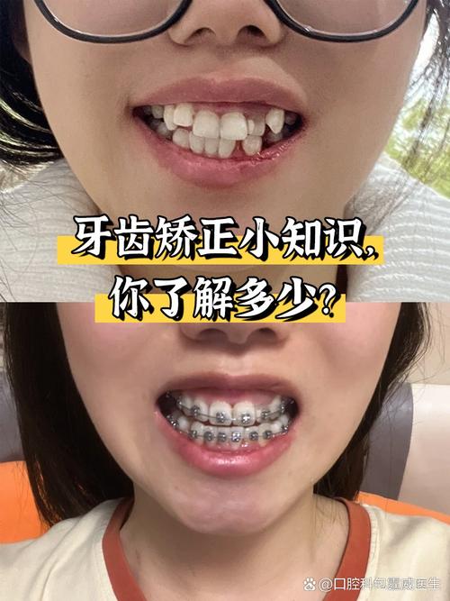 牙齿不整齐到底要不要矫正?不矫正会有什么影响?-图2 牙齿不整齐到底要不要矫正?不矫正会有什么影响?-图2