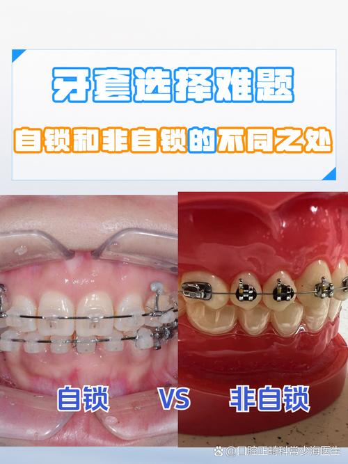 牙齿矫正自锁托槽图片-图1 牙齿矫正自锁托槽图片-图1