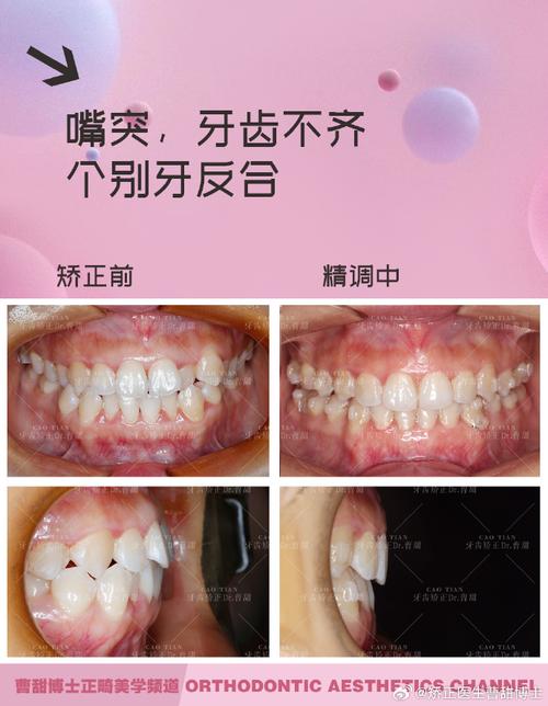 矫正牙齿能改变凸嘴吗？效果如何？-图2