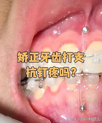 矫正牙齿疼不疼？治疗过程中痛感如何？-图3