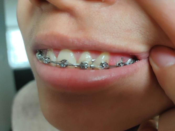 矫正牙齿牙龈增生图片-图1