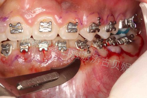 矫正牙齿牙龈增生图片-图2