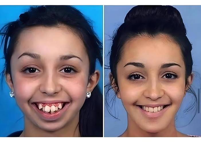 从图片看牙齿矫正变化过程,有哪些关键转变阶段?-图2 从图片看牙齿矫正变化过程,有哪些关键转变阶段?-图2