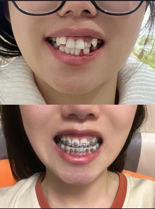 牙齿开合矫正前后图片-图2