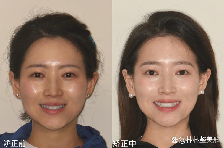 龅牙矫正前后图片对比，效果究竟有多惊艳？-图2
