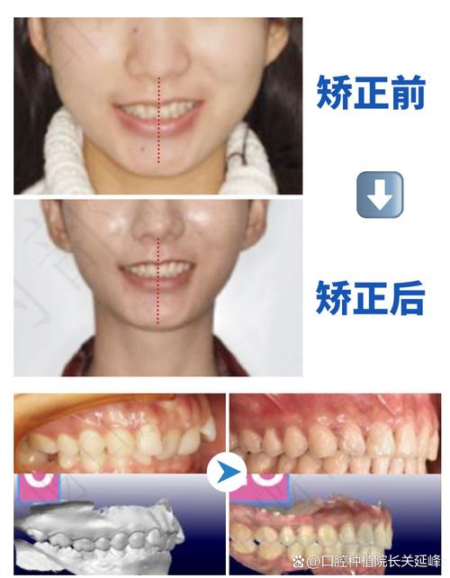 牙齿深覆合矫正容易吗？难度和周期具体如何？-图1