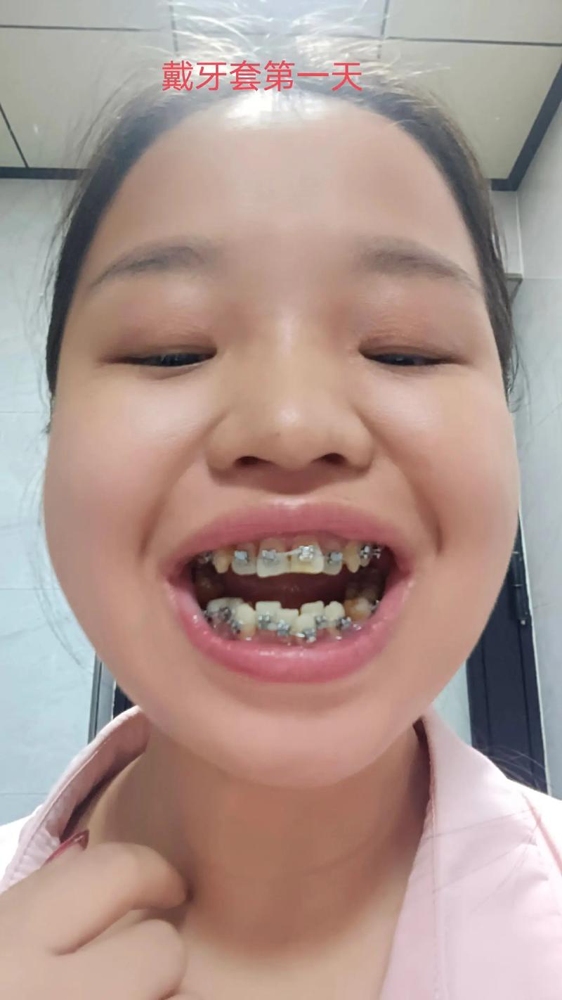 牙齿矫正钢丝越换越粗-图1