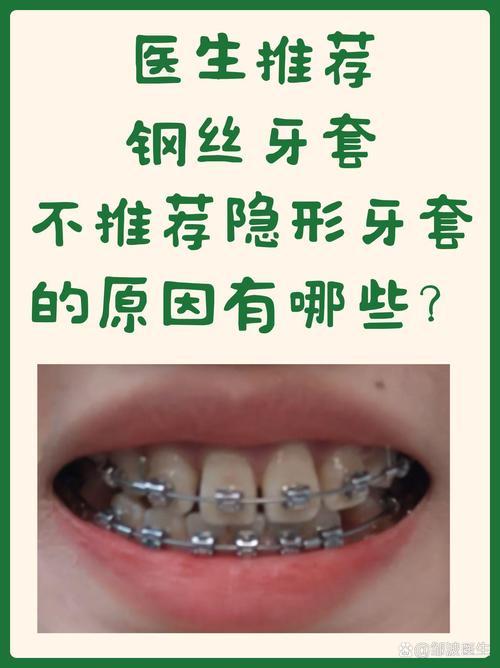 牙齿矫正钢丝越换越粗-图2