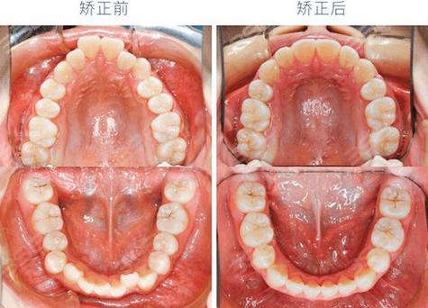 30岁矫正牙齿,真的会留下不可逆的后遗症吗?-图2 30岁矫正牙齿,真的会留下不可逆的后遗症吗?-图2