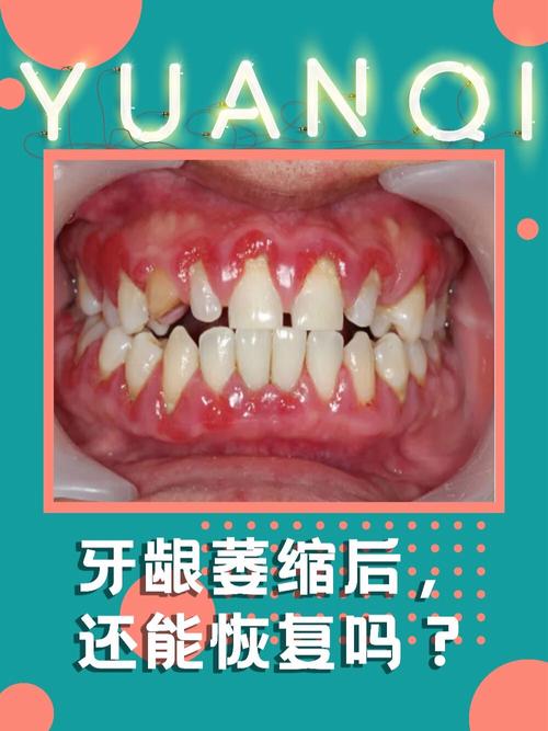 牙齿矫正后牙龈萎缩图，为何会出现牙龈萎缩？-图2