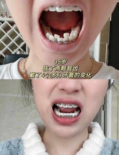牙齿矫正一般几个月能开始看到效果?之后会越来越明显吗?-图1 牙齿矫正一般几个月能开始看到效果?之后会越来越明显吗?-图1