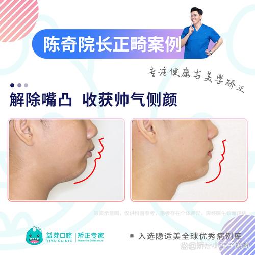 牙齿矫正对下巴的影响究竟有多大？-图2