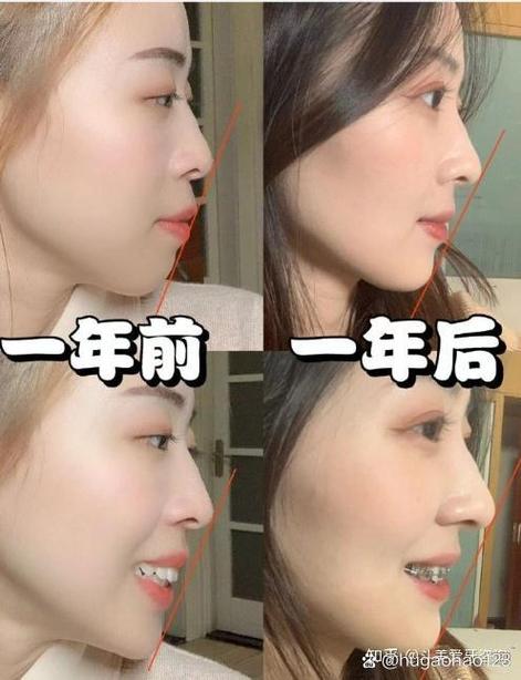 深圳在哪里矫正牙齿好-图2