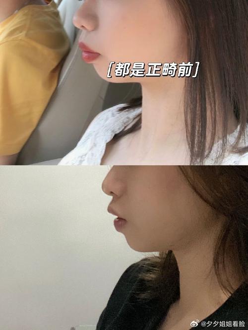 嘴前突 矫正牙齿案例-图2