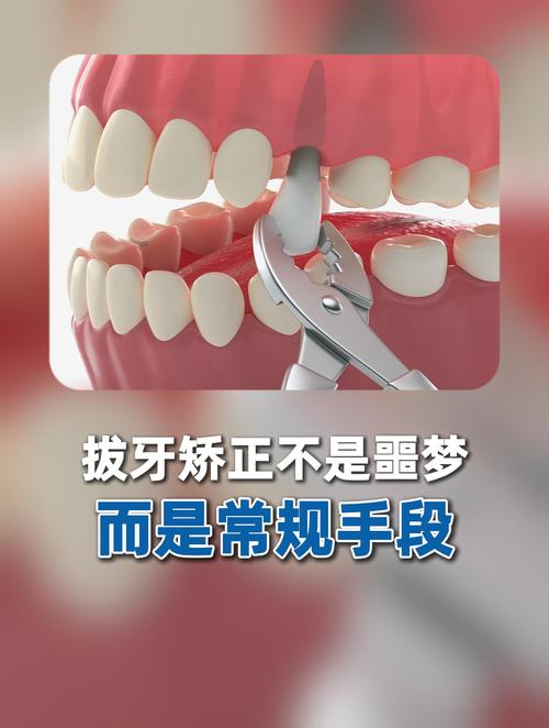 拔牙矫正牙齿过程图片能看清哪些关键步骤？-图1