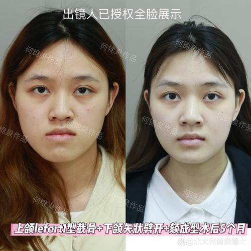 牙齿矫正后脸越来越歪-图2