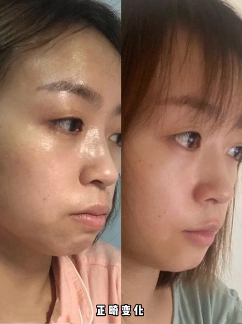 牙齿矫正后脸越来越歪-图1