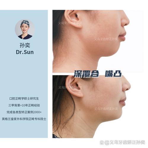 牙齿矫正会让嘴变突吗？30秒看矫正是否真的导致嘴前突-图1