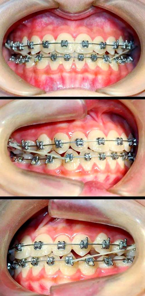 天包地矫正效果图能反映真实矫正效果吗？-图2