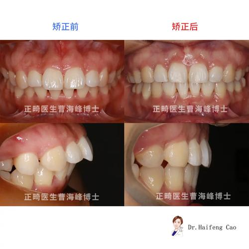 矫正牙齿能改善嘴突吗？-图3