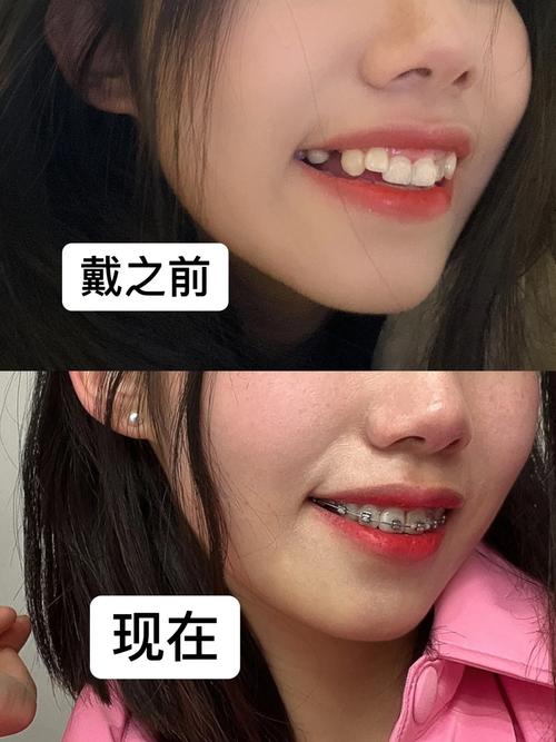 成年人矫正牙齿还来得及吗?年龄不是障碍?-图2 成年人矫正牙齿还来得及吗?年龄不是障碍?-图2