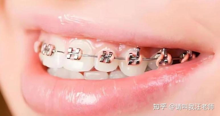 22岁矫正牙齿来得及吗?成年人还有机会吗?-图2 22岁矫正牙齿来得及吗?成年人还有机会吗?-图2