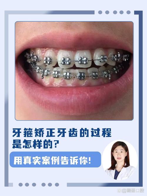 矫正牙齿哪个过程最疼-图3