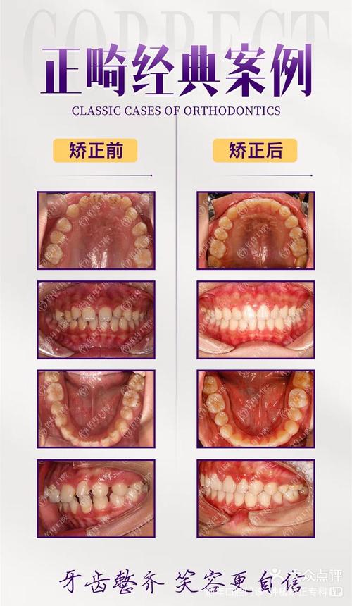 大连牙齿隐形矫正效果如何?价格与时间如何?适合哪些人?-图3 大连牙齿隐形矫正效果如何?价格与时间如何?适合哪些人?-图3