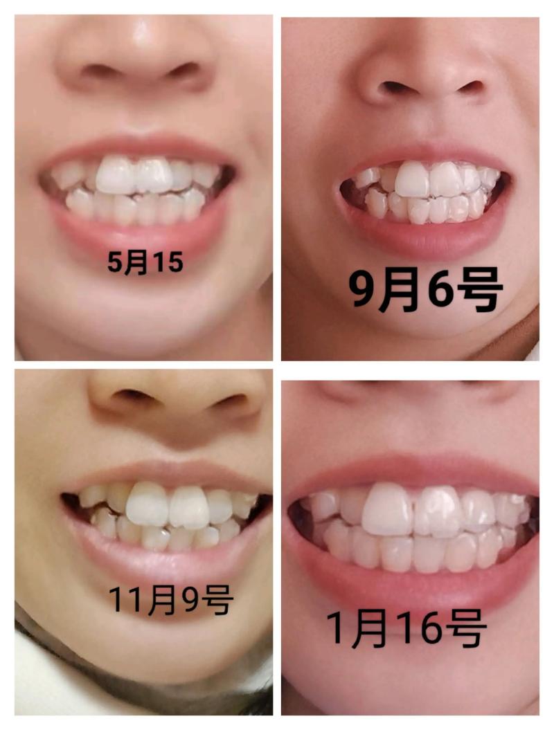 牙齿矫正带牙套要多久-图3 牙齿矫正带牙套要多久-图3