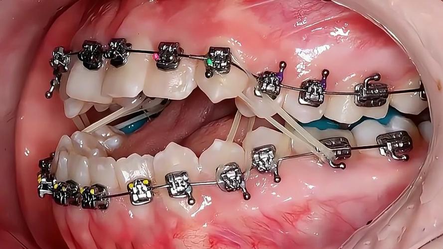 牙齿矫正必须带牙套吗-图1