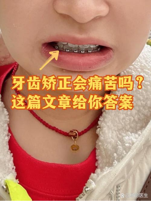 矫正牙齿不拔牙会龅牙-图2