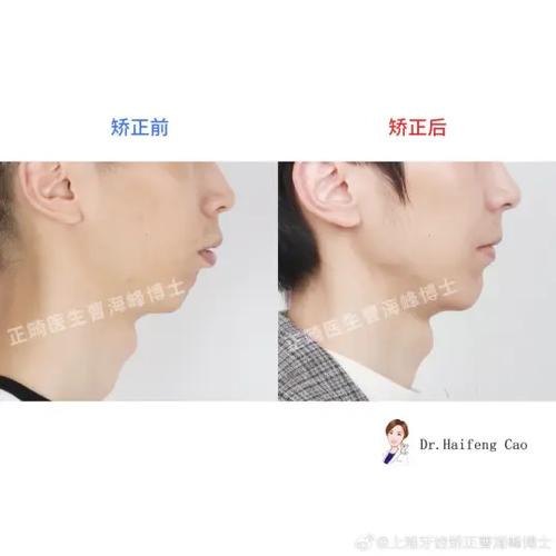 33岁矫正牙齿，会有哪些不可忽视的危害？-图2