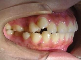 男孩矫正牙齿,拔牙是必须的吗?矫正效果会更好吗?-图3 男孩矫正牙齿,拔牙是必须的吗?矫正效果会更好吗?-图3