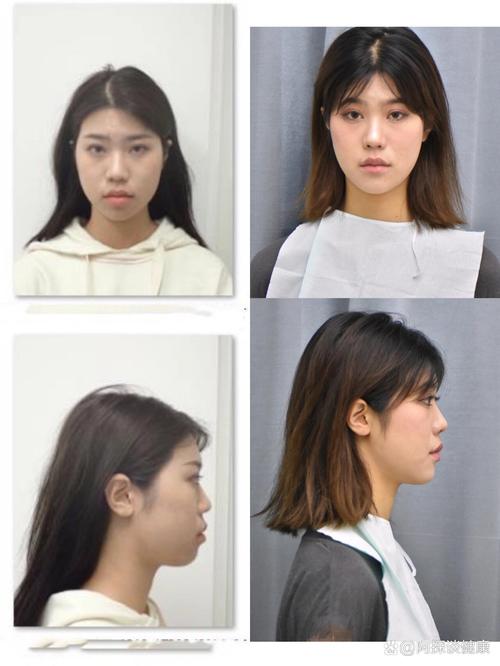 矫正牙齿前后脸型对比-图2