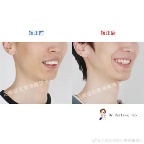 20岁矫正牙齿的危害-图3