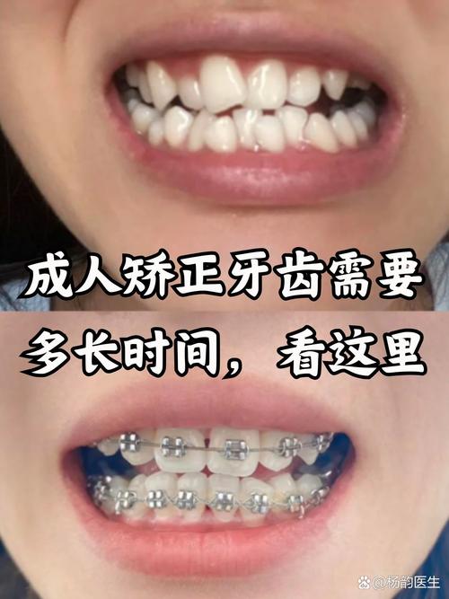 17岁矫正牙齿一般需要多长时间?-图2 17岁矫正牙齿一般需要多长时间?-图2