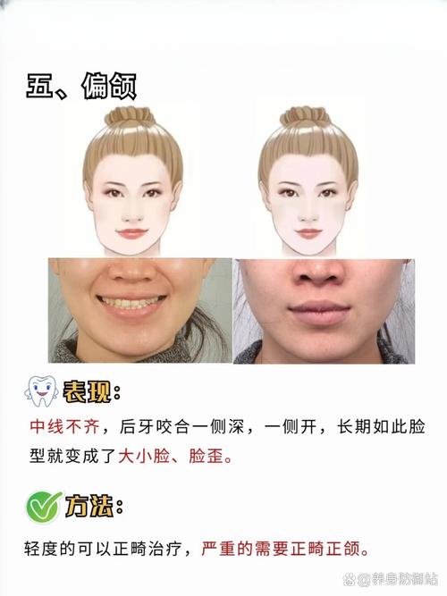 牙齿矫正会改变脸型么-图1