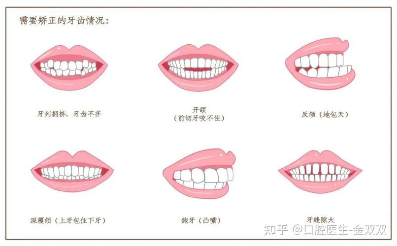 成人牙齿矫正一般需要多久？-图2