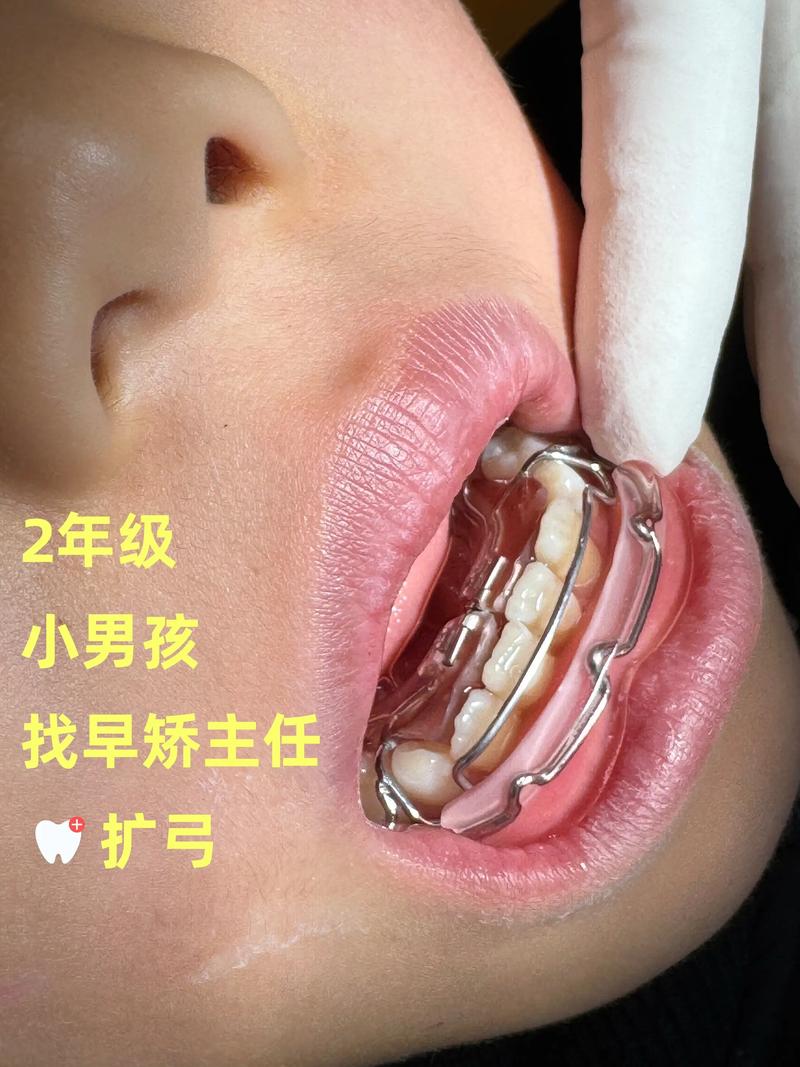 换牙期可以矫正牙齿吗-图1