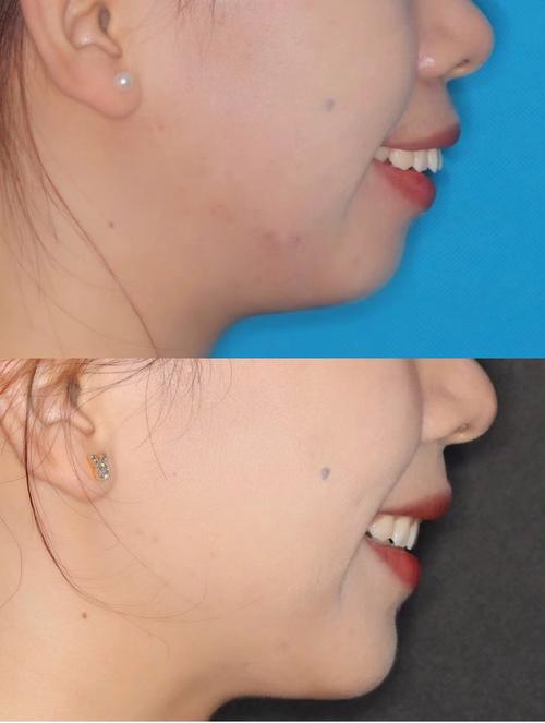 牙齿矫正后脸型会变吗？矫正真的能改变脸型吗？-图1