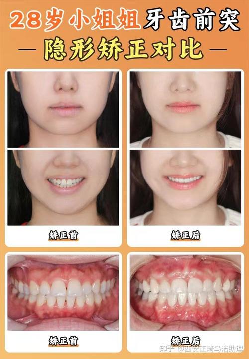 30岁了矫正牙齿还来得及吗？-图1