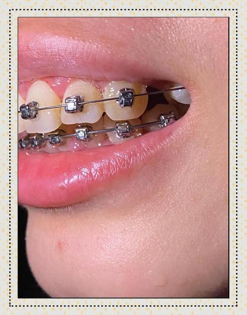 哺乳期矫正牙齿安全吗？-图1