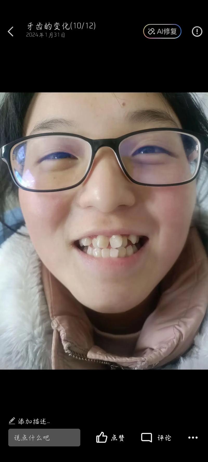 33岁矫正牙齿还来得及吗?成年人矫正有年龄限制吗?-图3 33岁矫正牙齿还来得及吗?成年人矫正有年龄限制吗?-图3